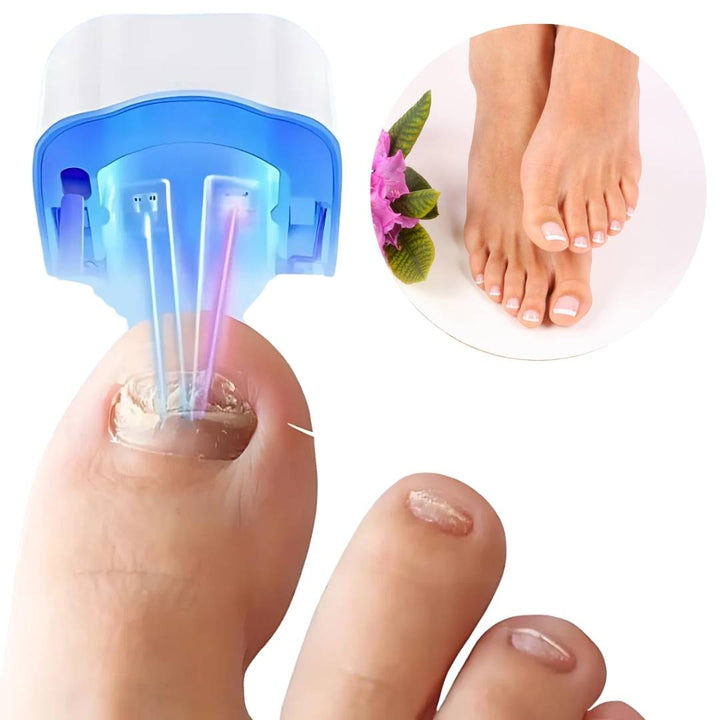 "Hochpräzises Nagelpilz-Lasergerät, nicht-invasiv, beige Gehäuse, handlich für schmerzfreie Heimbehandlungen."