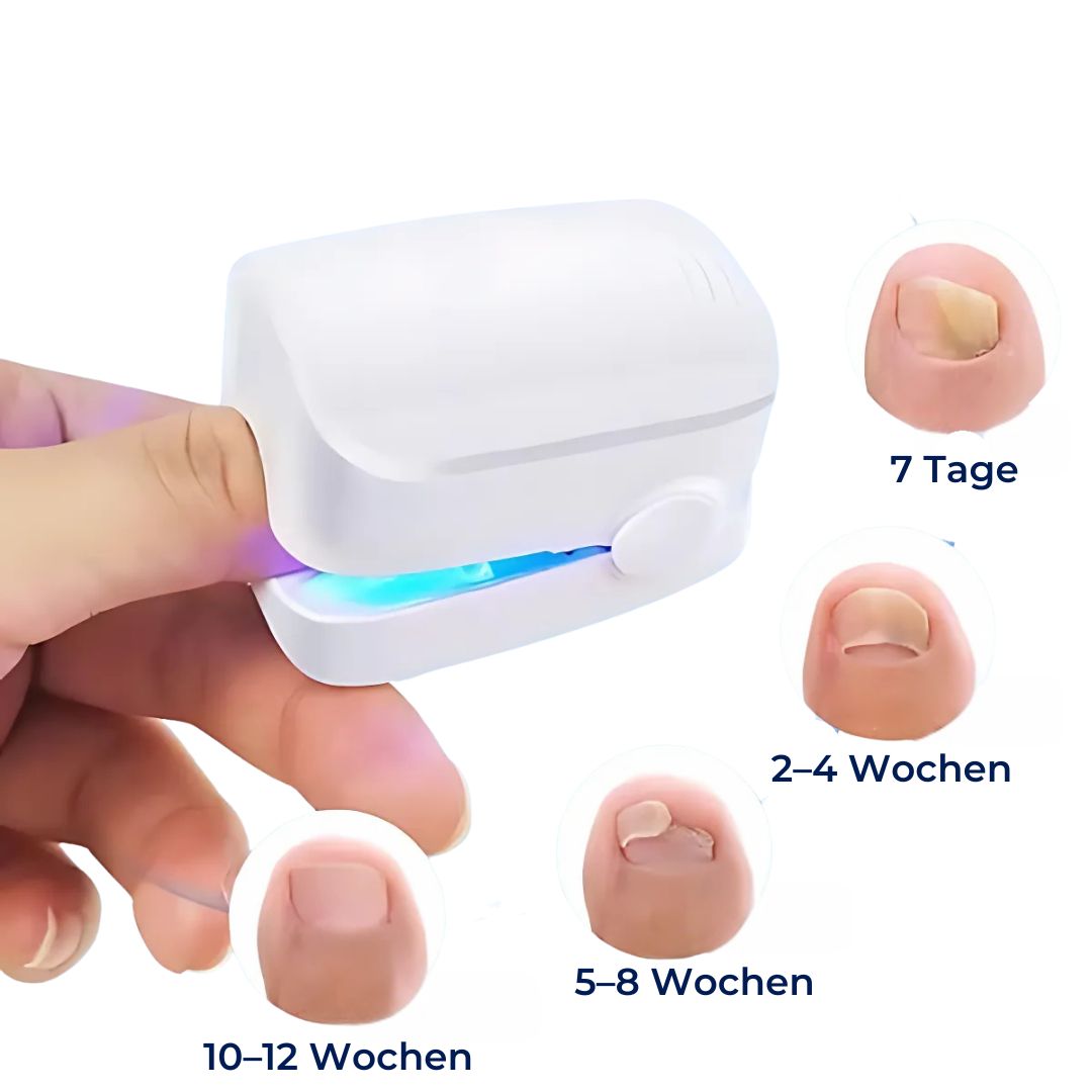 "Hochpräzises Nagelpilz-Lasergerät, nicht-invasiv, beige Gehäuse, handlich für schmerzfreie Heimbehandlungen."