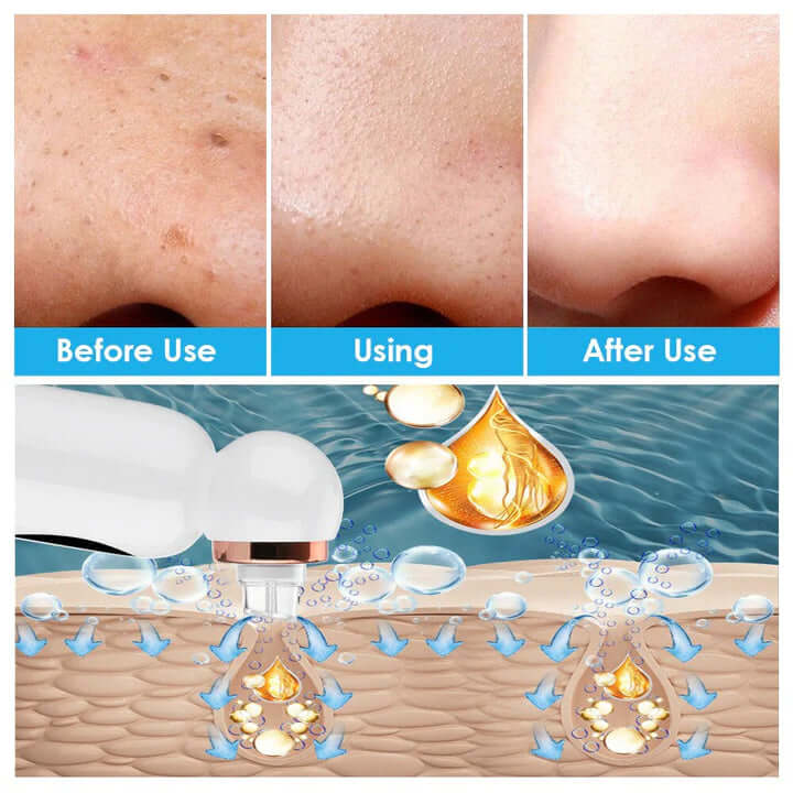 Appareil de nettoyage du visage - tire-comédons et hydrodermabrasion