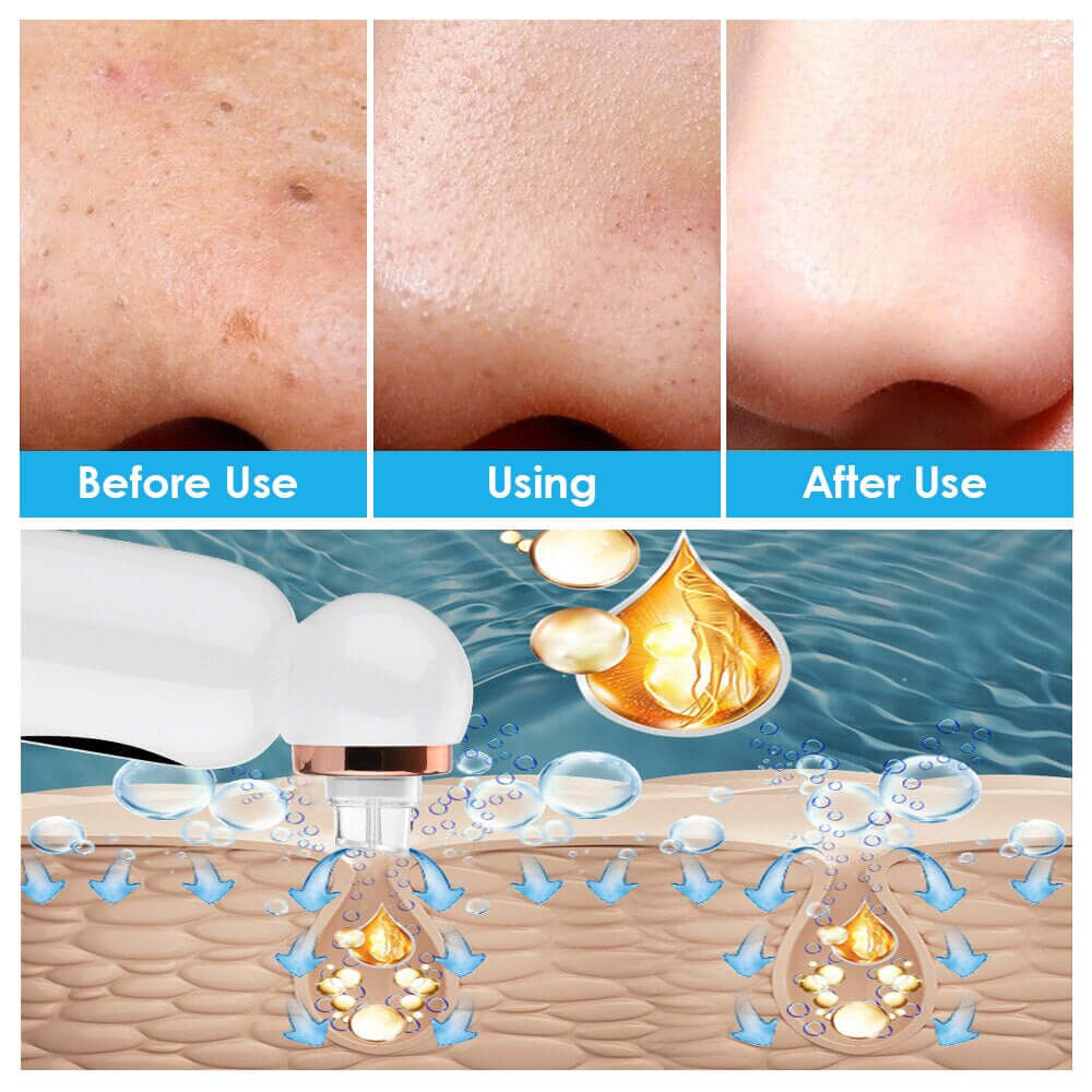 Porenreiniger & Hydrodermabrasion Gerät