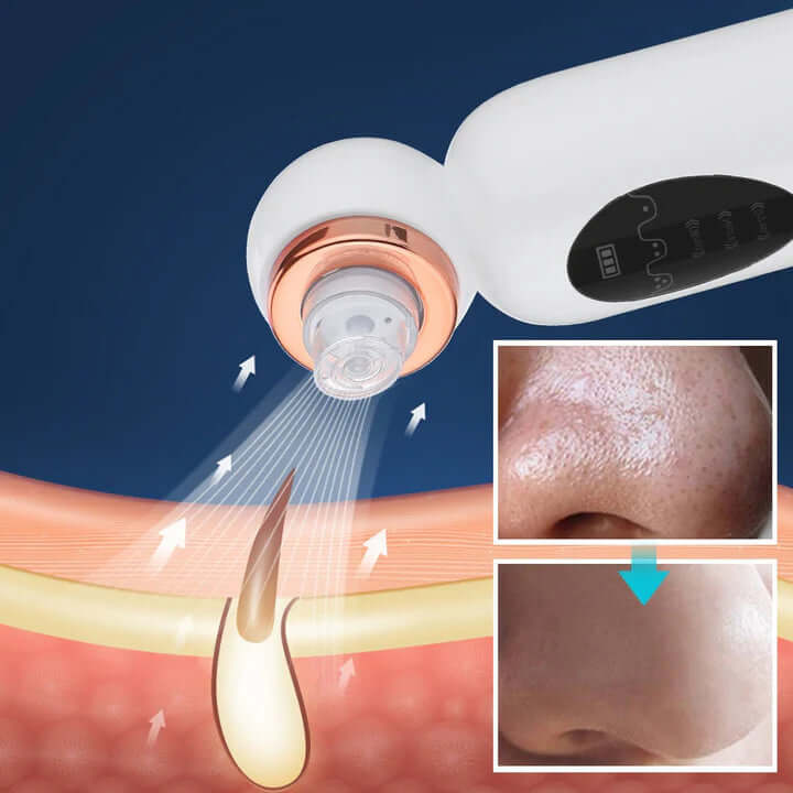 Appareil de nettoyage du visage - tire-comédons et hydrodermabrasion
