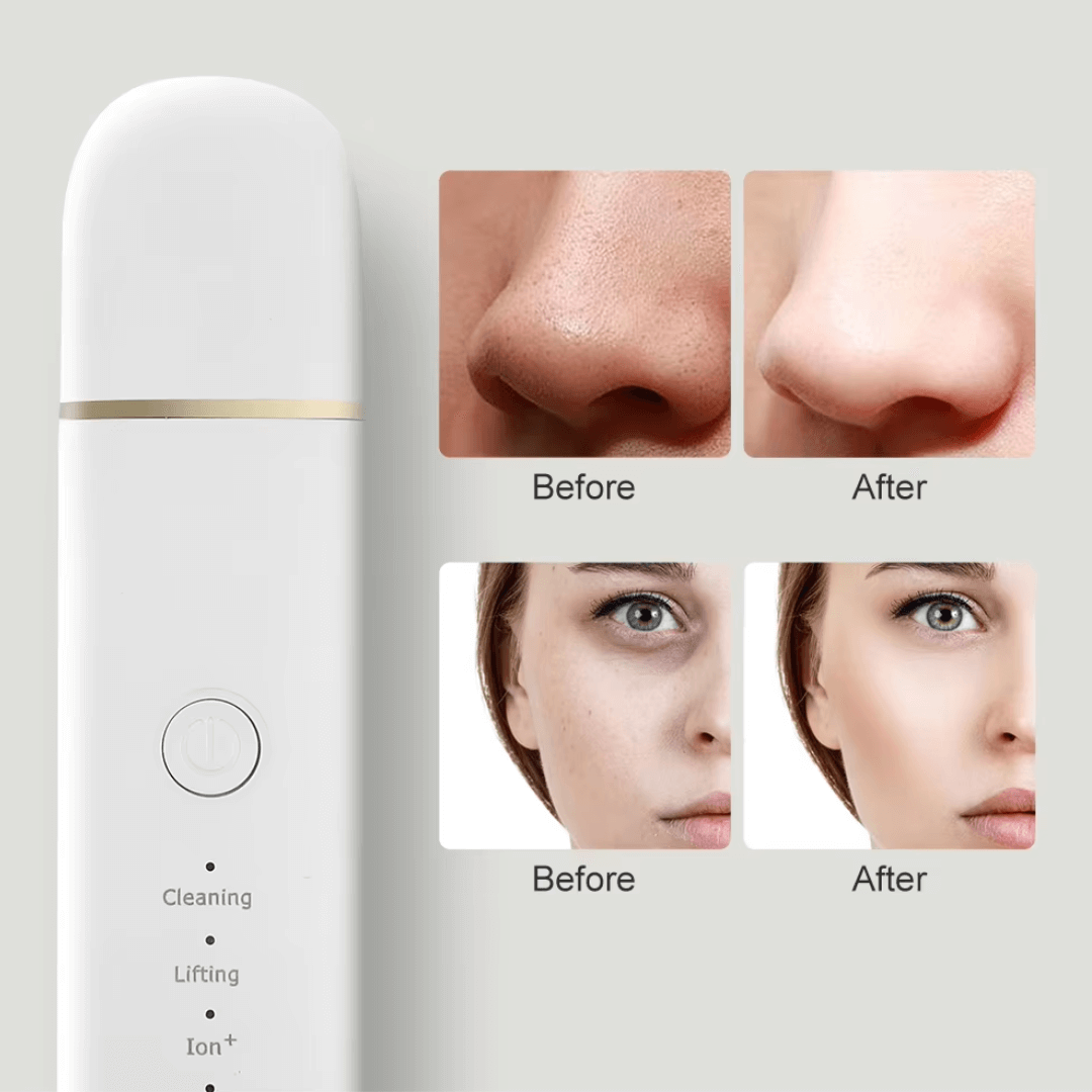 Nettoyeur de peau à ultrasons, nettoyeur de pores, éliminateur de points noirs