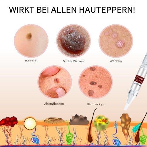 "Hautfleckenentferner mit natürlicher Formel in Pumpflasche, ideal für zu Hause, schnelle Ergebnisse, invasionsfreie Anwendun