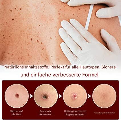 "Hautfleckenentferner mit natürlicher Formel in Pumpflasche, ideal für zu Hause, schnelle Ergebnisse, invasionsfreie Anwendun