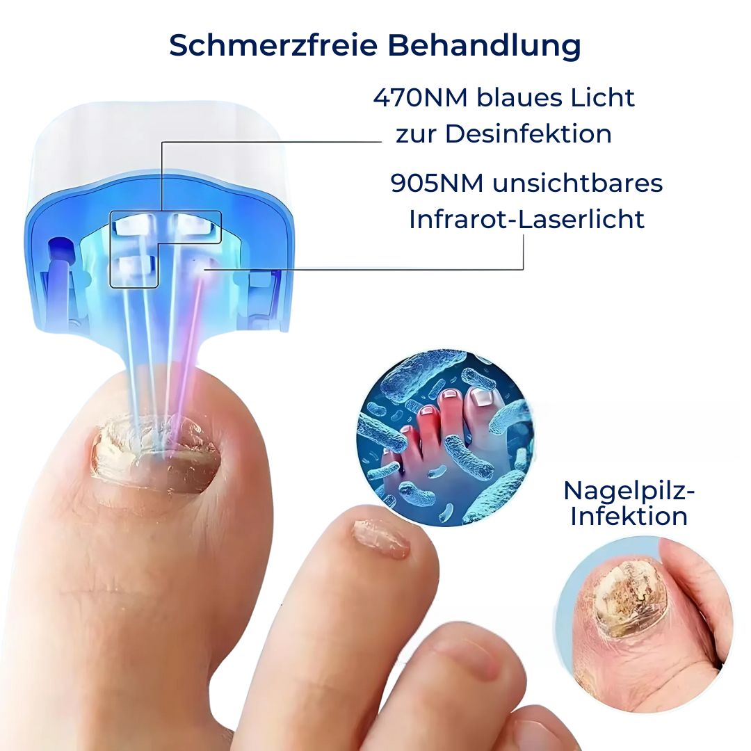 "Hochpräzises Nagelpilz-Lasergerät, nicht-invasiv, beige Gehäuse, handlich für schmerzfreie Heimbehandlungen."